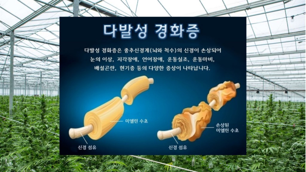 다발성경화증